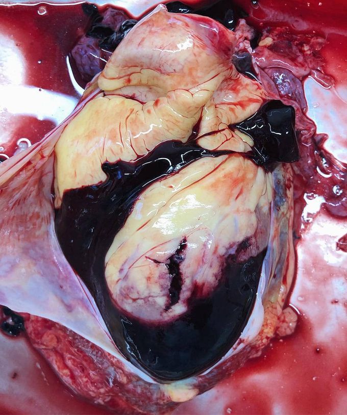 Hemopericardium