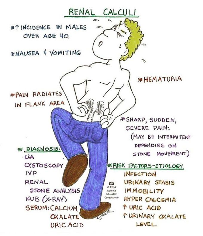 Renal calculi