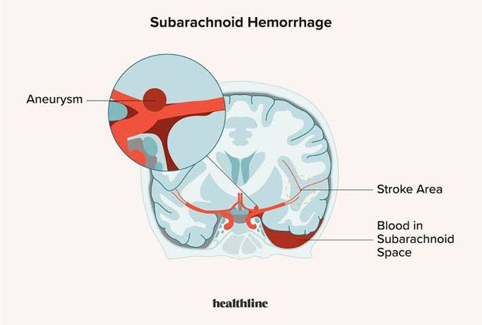 Symptoms of subarachnoid hemorrhage