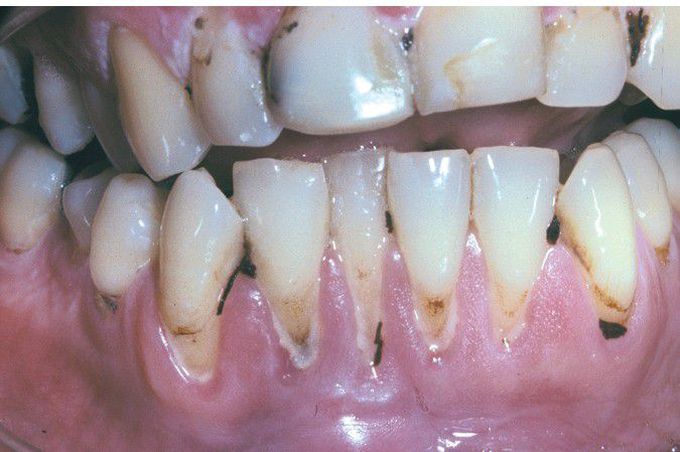 Smokeless Tobacco–related Gingival Recession