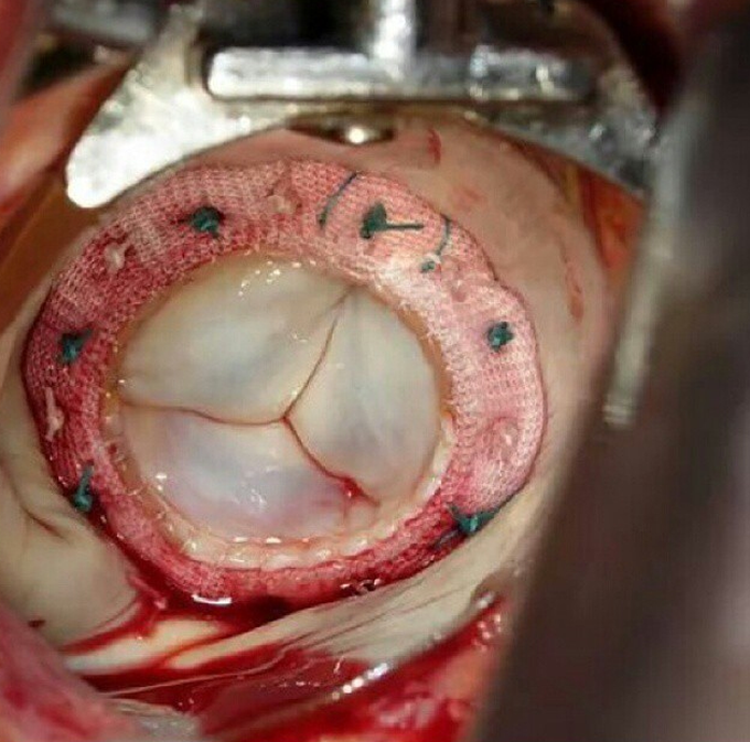 Tricuspid valve