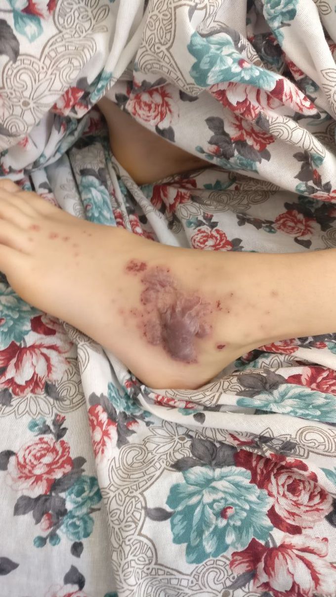 Hemorrhagic vasculitis