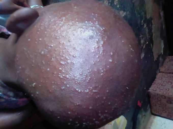 Dermatology