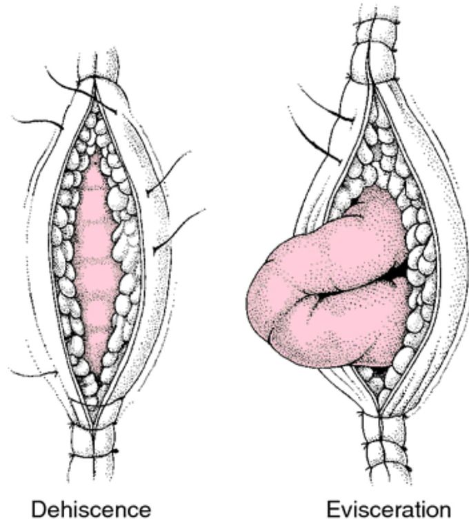 Wound Dehiscence and Evisceration