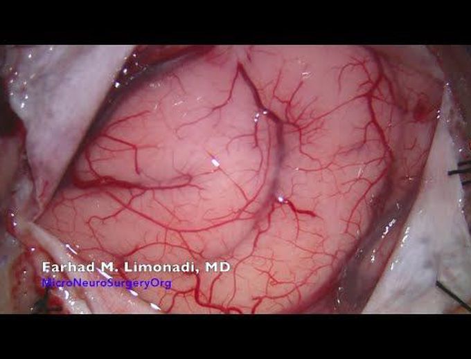Brain Surgery : Surgical resection of glioblastoma multiforme (GBM)