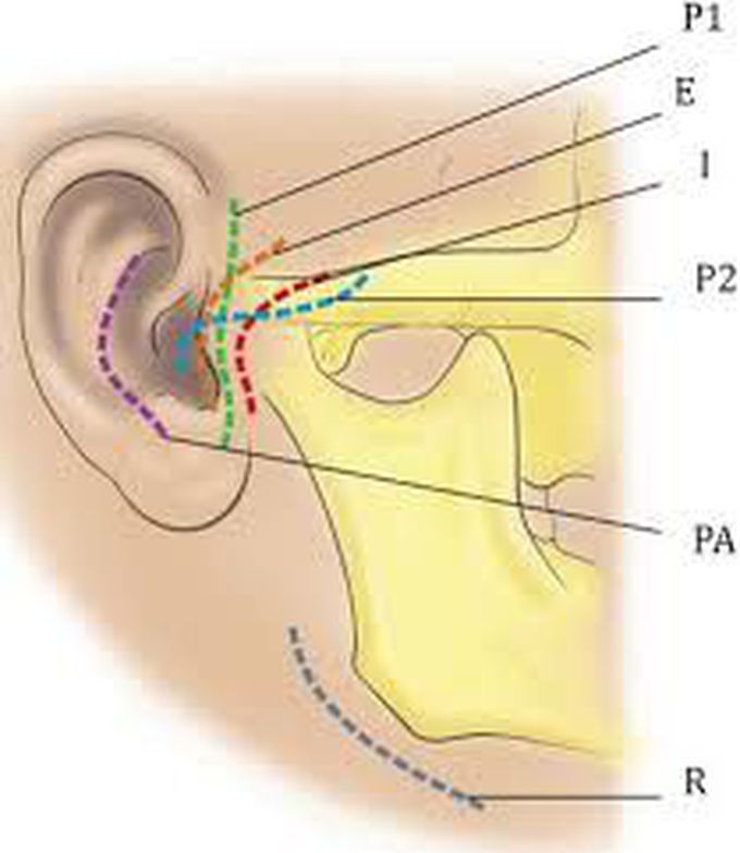 Surgical approach for tmj ankylosis