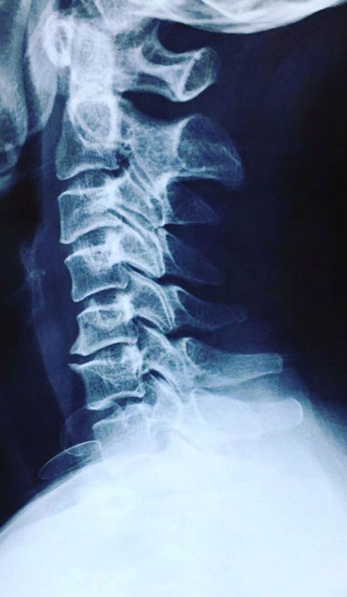 Cervical CT