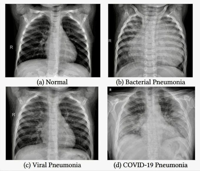 Chest X-ray Review