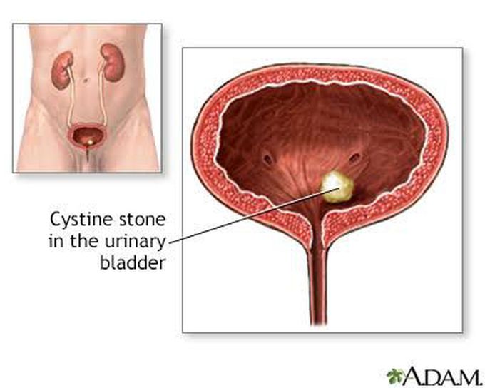 Cystine stones symptoms
