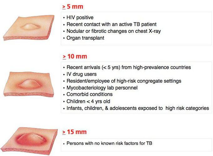 Classification of the PPD (Tuberculin Skin Test) Reaction