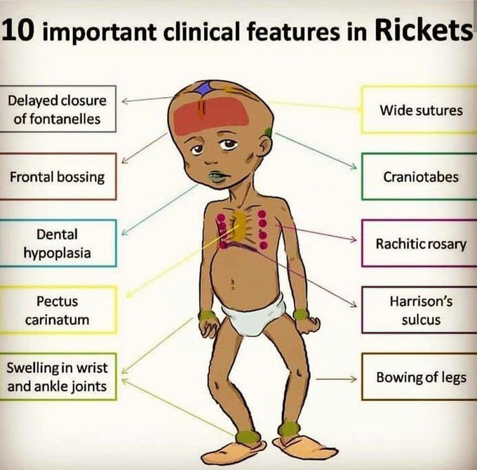 Osteomalacia And Rickets Knowledge AMBOSS