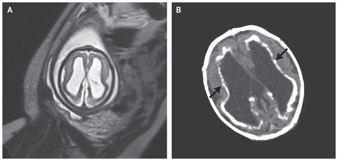 Congenital Cytomegalovirus Infection