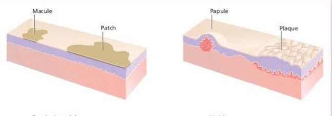 macule vs papule