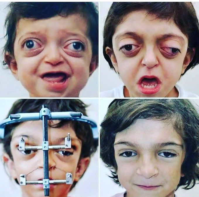 Crouzon Syndrome