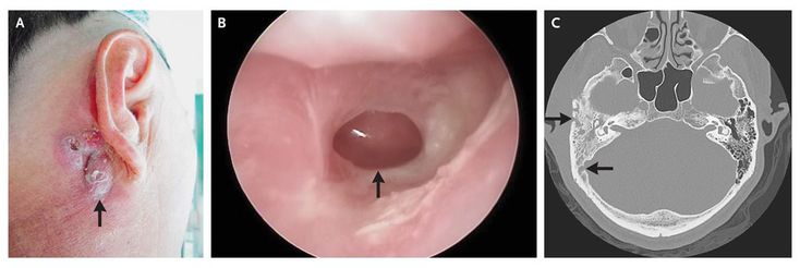 mastoiditis