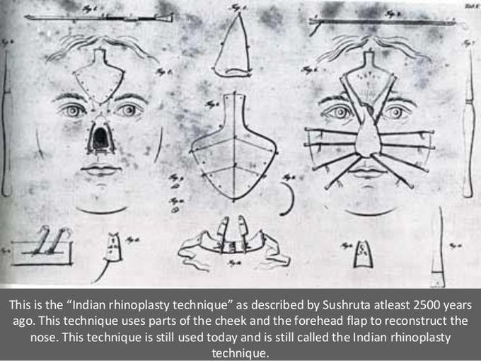 Rhinoplasty techniques