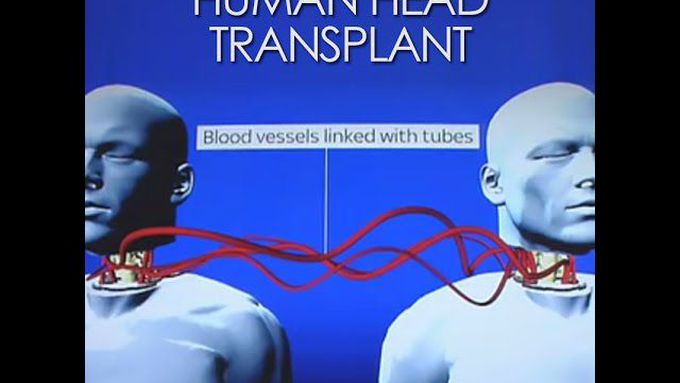 The world’s first human head transplant is scheduled for Dec 2017