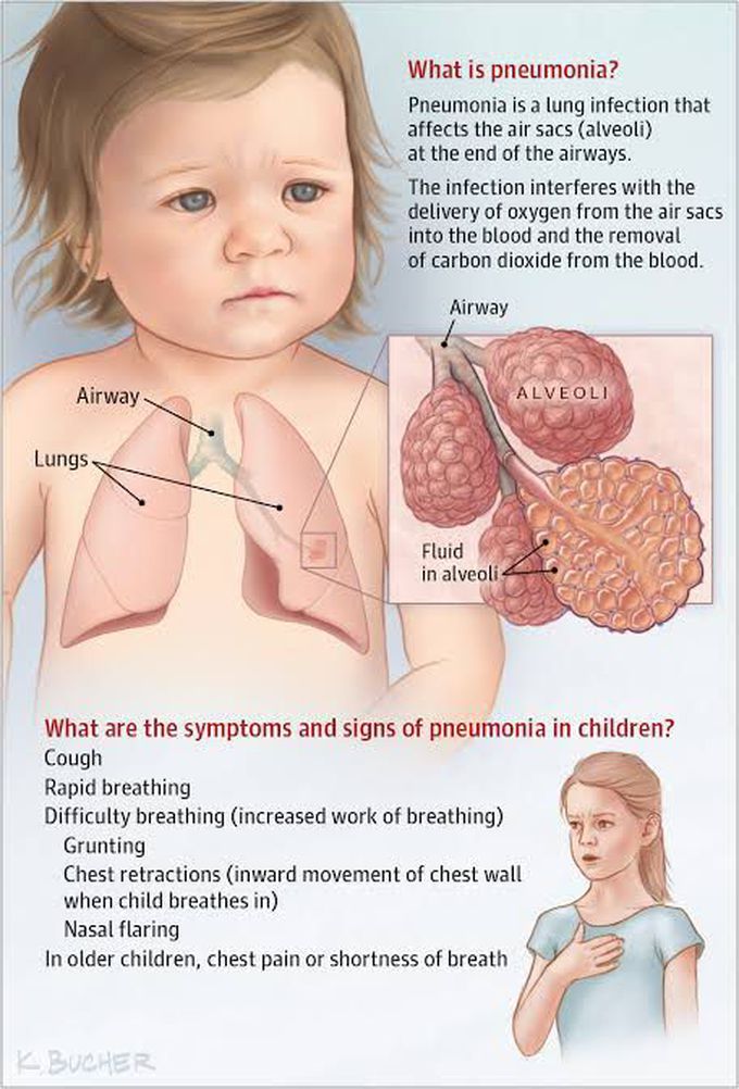 Pneumonia