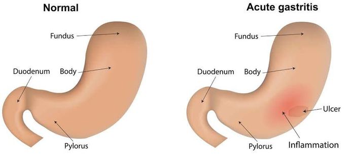 Acute Gastritis Symptoms Medizzy 