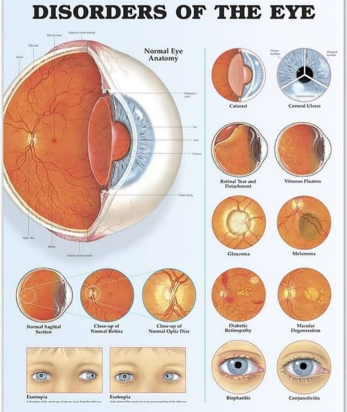 Eyes disorders