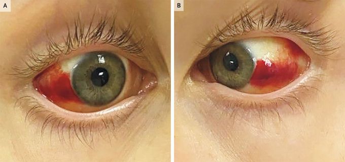 Subconjunctival Hemorrhage in Leptospirosis