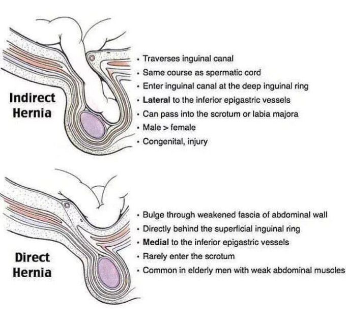 Direct Vs Indirect Hernia