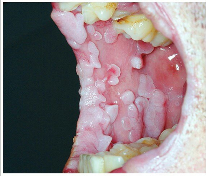 What is the likely cause of these pain less oral lesions?