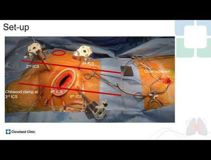 Robotically-Assisted Mixoma Resecntion: Tips and Tricks