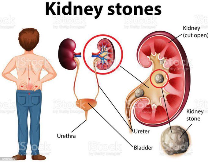Kidney stones