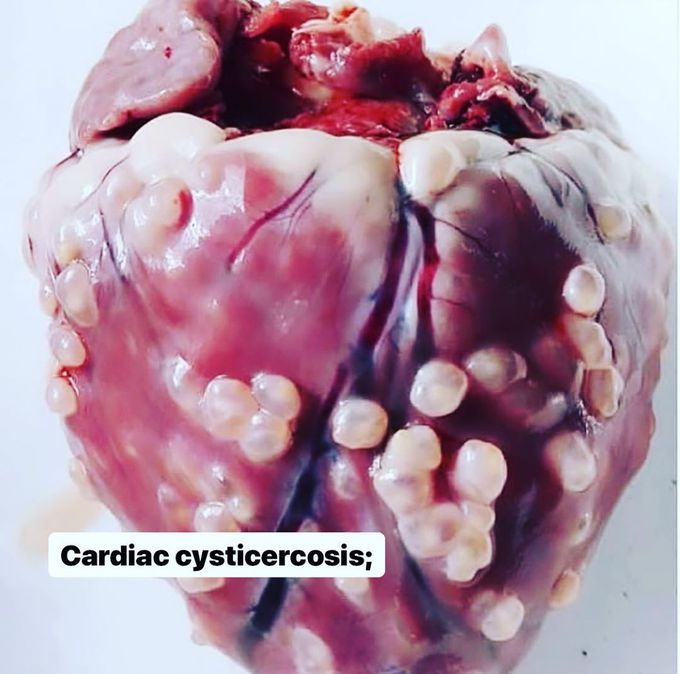 Cardiac Cysticercosis 