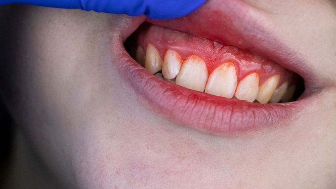 What are the signs and symptoms of gingivitis?