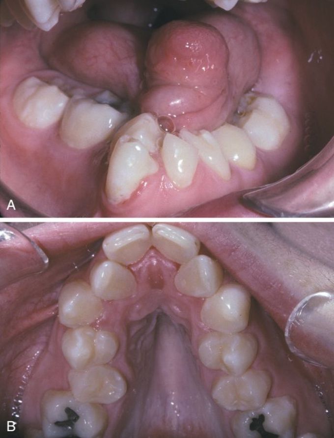 Microglossia