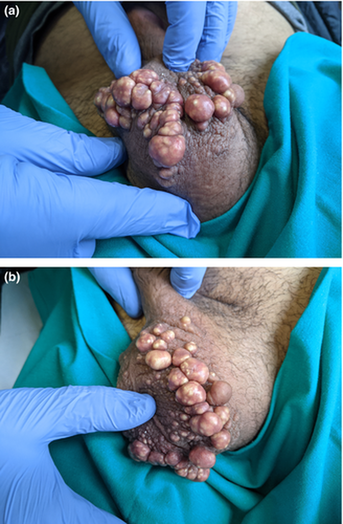 A 34-year-old Moroccan man with Fitzpatrick skin type IV presented to the sexually transmitted diseases centre with multiple painless nodules involving the scrotum. The first lesions had appeared when he was 15 years old and had increased progressively in number and size. The patient was concerned about cosmesis and discomfort; however, the condition had not interfered with sexual relations or fertility. His medical history was unremarkable. There was no history of trauma, ulcers or infections of the genital area, and the patient denied any other skin diseases. He worked as a manual labourer.

On clinical examination almost the entire scrotal wall was seen to be covered by multiple, firm, hard, subcutaneous nodules with sparing of the median raphe skin. The largest nodule was about 20 mm in size. Laboratory investigations showed serum calcium, phosphate, and parathyroid hormone levels to be within the normal range. Ultrasonography of the testicles did not reveal any abnormalities.