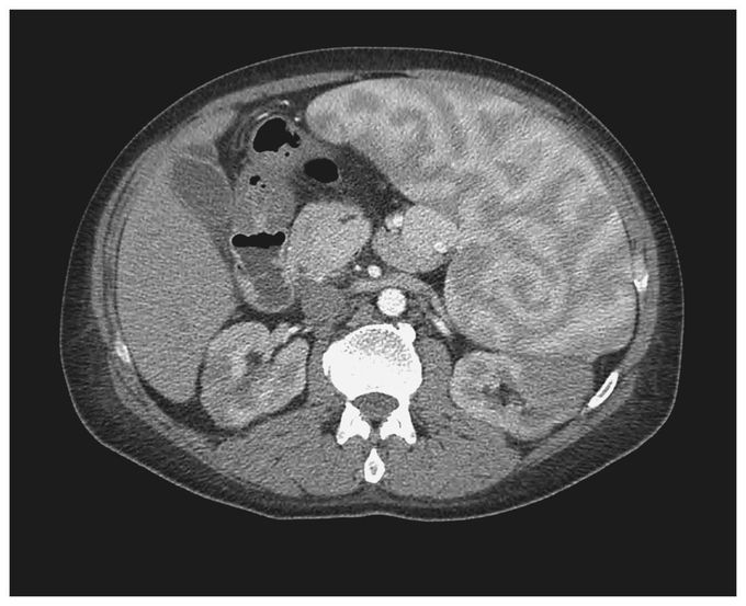 Enlarged Spleen with a Heterogeneous Pattern