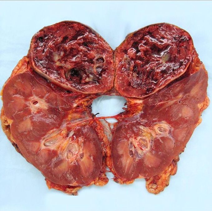  Kidney with pheochromocytoma!