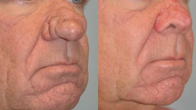 Rhinophyma symptoms