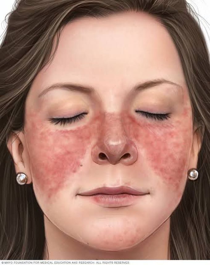 Malar-rash and photosensitivity