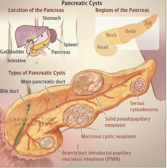 Pancreatic cyst