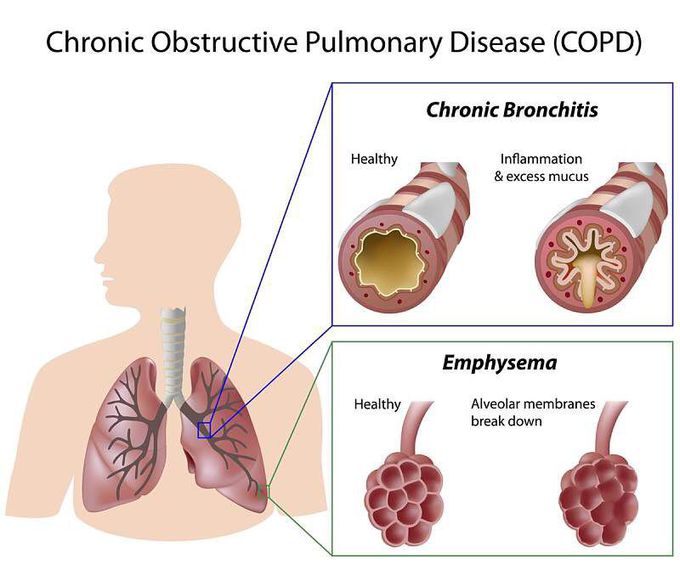 chronic obstructive pulmonary disease