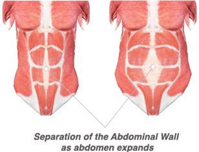 Diastasis recti