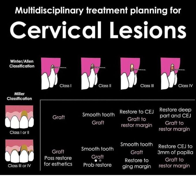 Cervical Lesions- Treatment