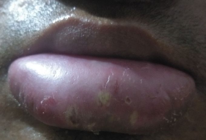 Swollen lips: problem started 3 days back as 2 to 3 sores on inner part of lower lip. Patient took anti histamines, declofenac and folic acid tablets to cure the problem.  But the problem was not resolved and finally resulted into this condition : As shown above in the photo !    Whats the probable diagnosis and treatment ???