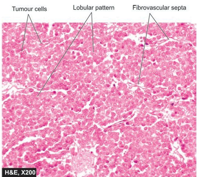 Dysgerminoma