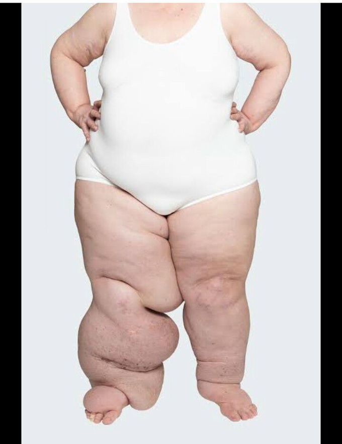 Elephantiasis