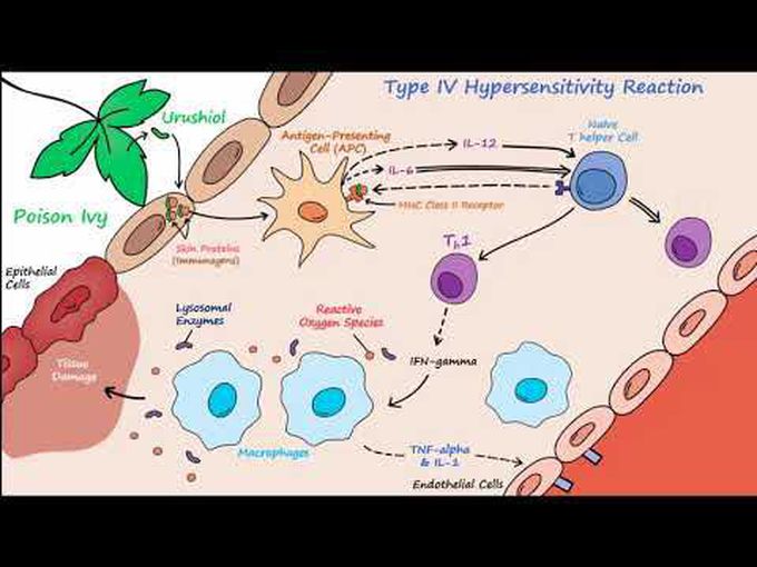 Hypersensitivity IV
