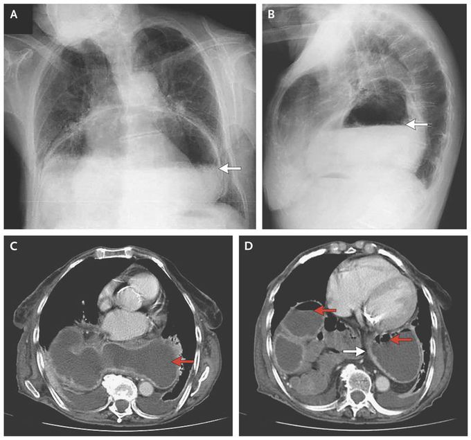 Large Hiatal Hernia