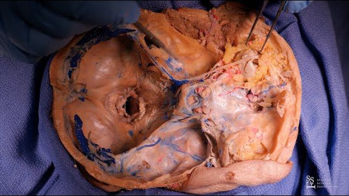 Anatomy Series - Intracranial Dissection - R. Shane Tubbs, PhD, PA-C