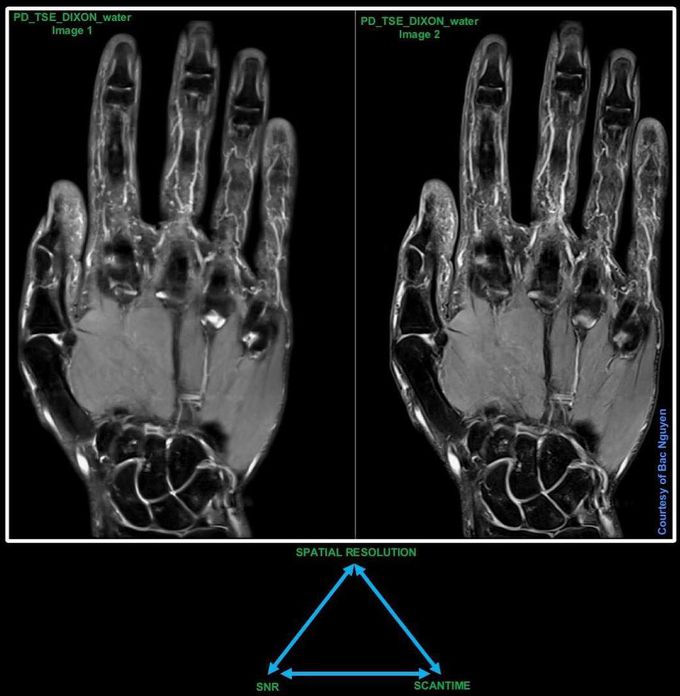 PDw Dixon Whole Hand @ Siemens 3T Skyra w/hand wrist - MEDizzy