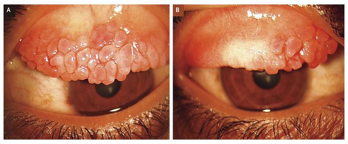 Giant Papillae in Vernal Keratoconjunctivitis