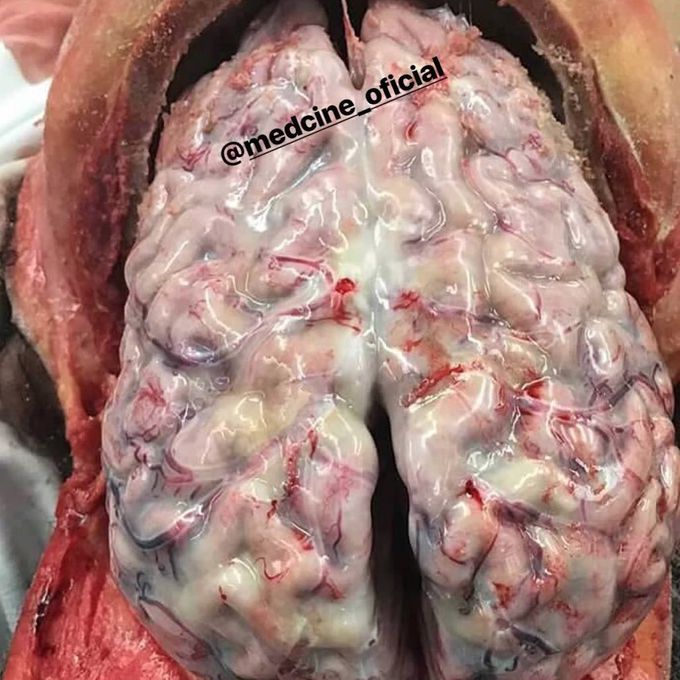 Bacterial Meningitis